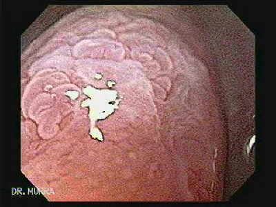 Barrett S Esophagus Ii The Gastrointestinalatlas