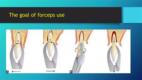 Mechanical Principles Involved In Tooth Extraction 1 Ppt