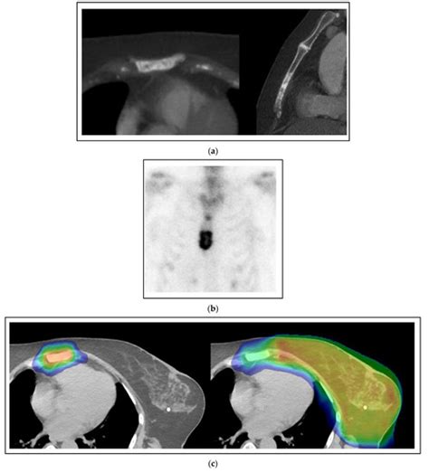 Current Oncology Free Full Text Stereotactic Radiation For