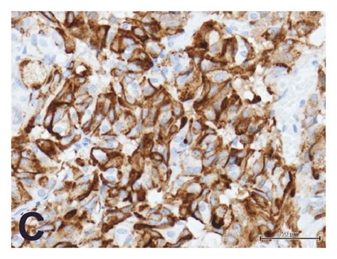 Pathology Of TSH Pituitary Adenoma Numerous Adenoma Cells With