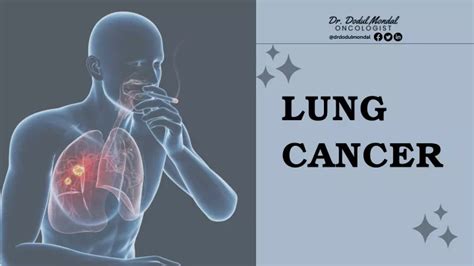 Ppt Lung Cancer Powerpoint Presentation Free Download Id 12173781