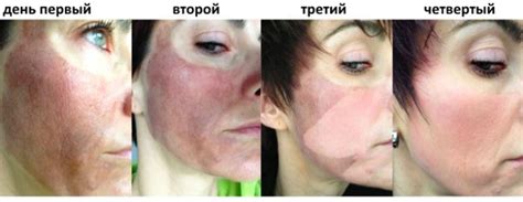 Уход после миндального пилинга кожи лица. Фото, отзывы