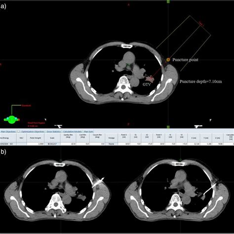 Representative Computed Tomography Scans Of An Example Of The Biopsy Download Scientific