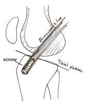 Acl Graft Failure Due To Graft Impingement Kneeguru