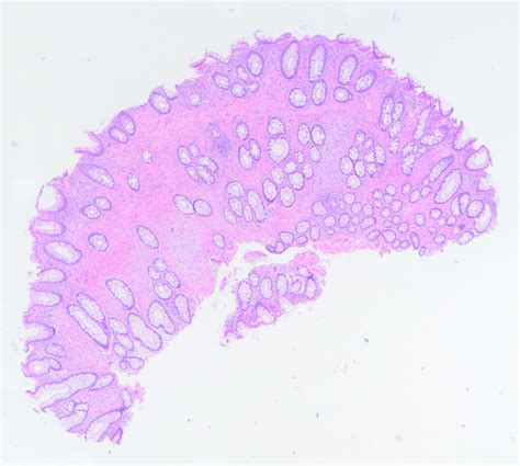 Hyperplastic Polyp Colon