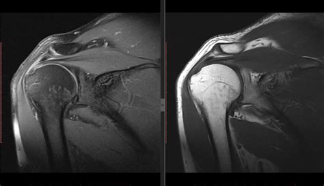 Shoulder Impingement MRI