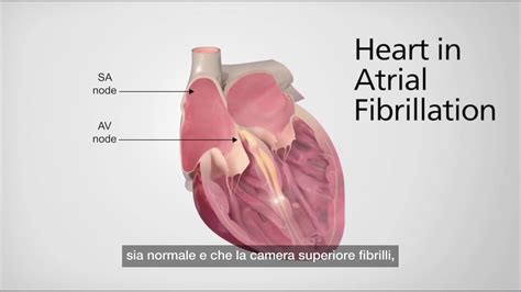 Il Cuore Durante La Fibrillazione Atriale Youtube