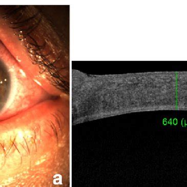 Three Month Postoperative Appearance Of Left Eye A Slit Lamp