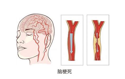 腦梗是“吃”出來的？勸告：3種食物易堵塞血管，再愛吃也管住嘴