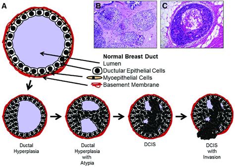 A: Natural history of breast ductal carcinoma in situ (DCIS) and ...