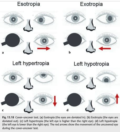 Questions Of The Week Diplopia Assessment Neuro Ophthalmology