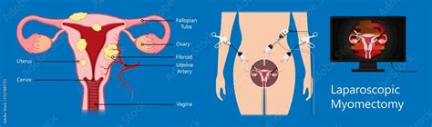 Laparoscopic Hysterectomy Medical Surgical Treat Cervix Ovary Subtotal Minimally Invasive