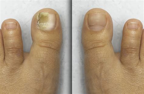 Stages Of Toenail Growing Back Purchase Cheapest Br