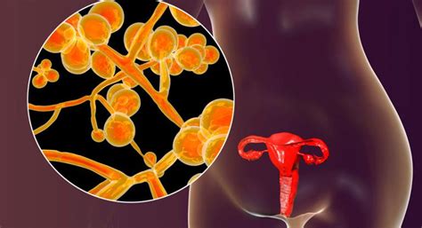 Tipos de candidiasis y síntomas FyzGY