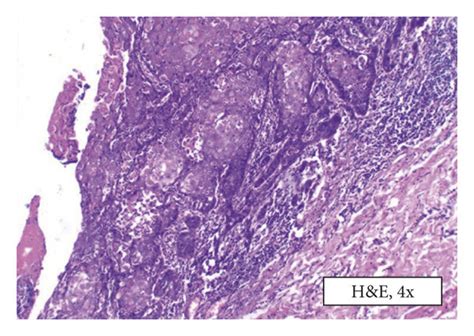 Excisional Biopsy Photomicrograph Of Excisional Biopsy Showing A B