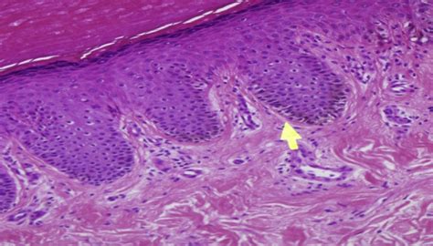 Histopathology Showed Mild Epidermal Acanthosis Increased Numbers Of