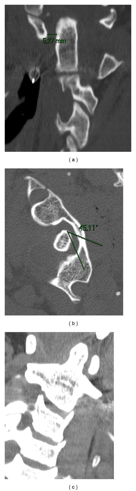 Computed Tomography Scans Showing An Atlanto Dental Interval Greater Download Scientific