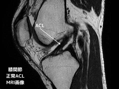 前十字靭帯損傷 さいたま整形外科クリニック