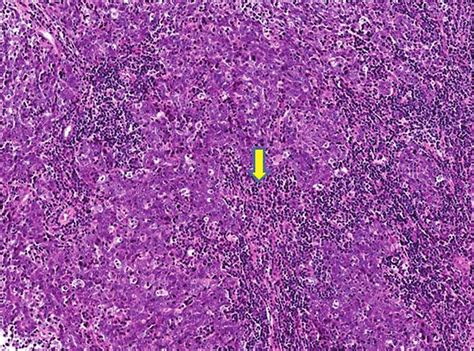 Nasopharyngeal Carcinoma Histology