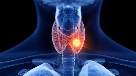 What are thyroid nodules? - YouTube