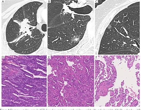 Figure From A Case Of Different Egfr Mutations In Surgically Resected