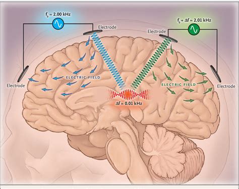 Figure From Waving Hello To Noninvasive Deepbrain Stimulation