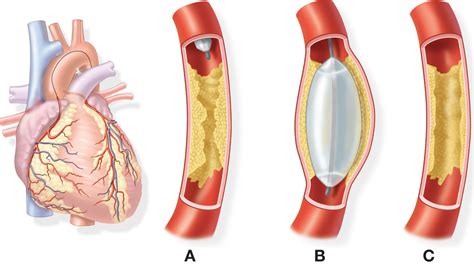 heart disease - Coronary Artery Disease