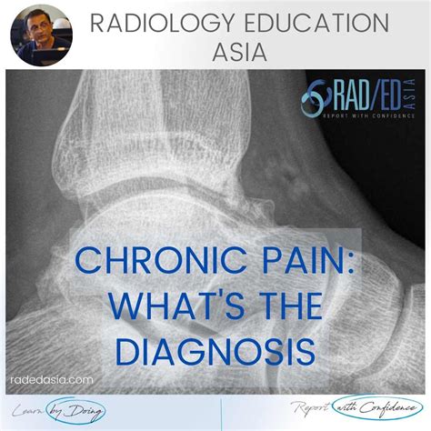 Ankle Impingement Radiology Anterior X Ray Video Radedasia