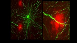 LA PROTEINA BETA AMILOIDE ALZHEIMER Y CATARATAS Enriquerubio Net