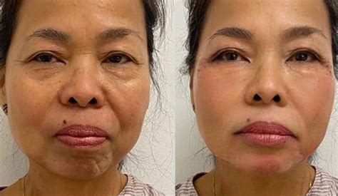 Non Surgical Facelift Non Surgical Facial Rejuvenation