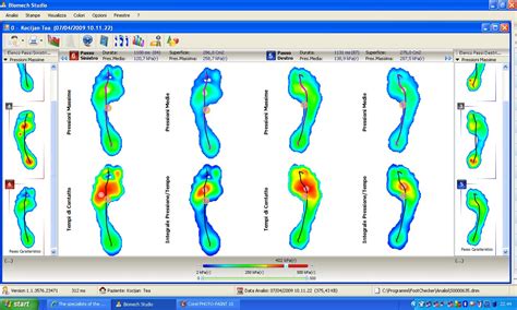 Analisi Computerizzata Del Passo Ortopedia Ospedale Srl