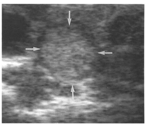 Thyroid Nodule Ultrasound