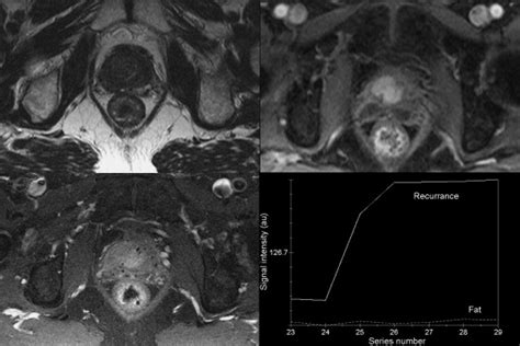 Dynamic Contrast Enhanced Mri In Prostate Cancer European Journal Of Radiology