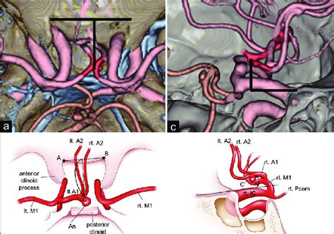 Preoperative Ct Angiograms A And C And The Schematic Diagrams B And Download Scientific