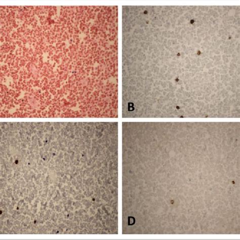 Histological Features Of The Patients Bone Marrow Clot Sections Prior