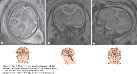 Malformations Of Cortical Development Radiology Key