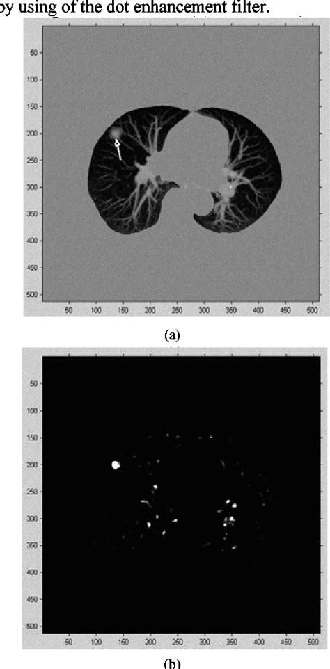 Figure 2 From Computer Aided Detection Of Lung Nodules Based On Voxel Analysis Utilizing Support