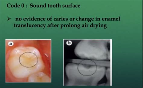 DHY 1250 Prevention Control Of Caries Chapter 25 Wilkins Flashcards