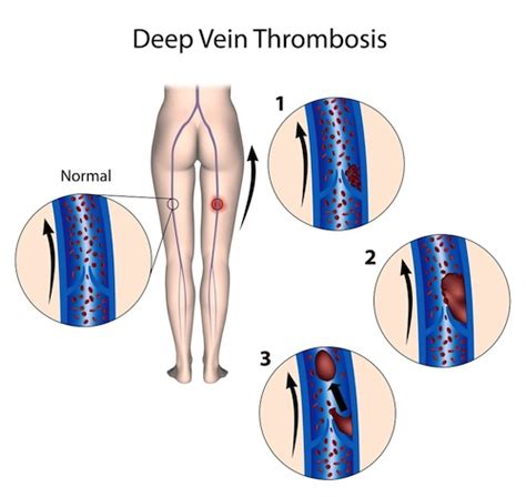 Phlebitis And Dvt What You Need To Know Vein Clinic In Kansas City