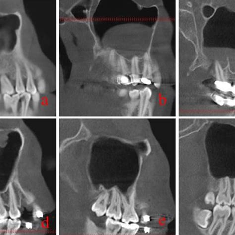 PDF Evaluation Of The Relationship Between The Maxillary Posterior