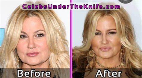 Jennifer Coolidge Plastic Surgery - Before and After