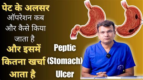 Peptic Stomach Ulcer पेट के अलसर का ऑपरेशन कब और कैसे किया जाता है और इसमें कितना खर्चा आता