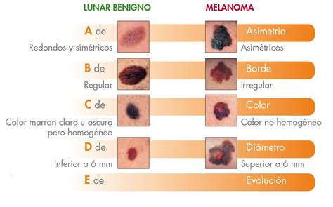 C Mo Diferenciar Los Lunares Benignos De Los Malignos Lunares En La