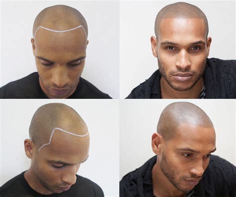 Everything You Need To Know About Hairline Tattoos A Comprehensive