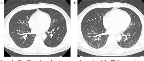 Figure From Bronchial Thermoplasty For Severe Asthma With Mucus