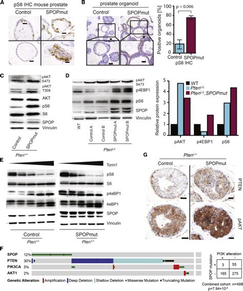 Spop Mutation Drives Prostate Tumorigenesis In Vivo Through Coordinate