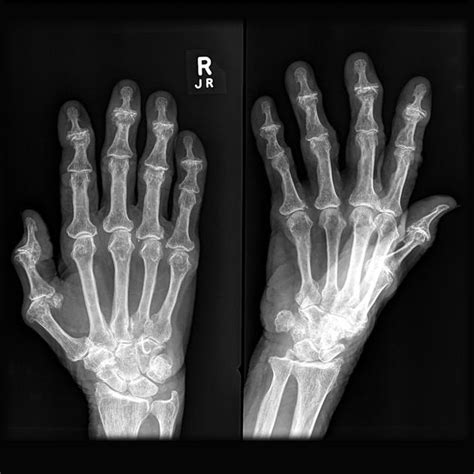 Osteoarthritis of the hands | Radiology Case | Radiopaedia.org