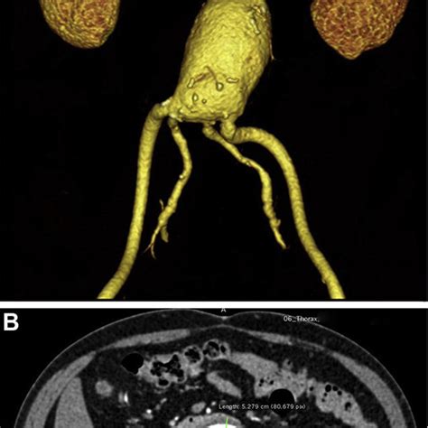 Preoperative Three Dimensional Reconstruction A And Axial Computed