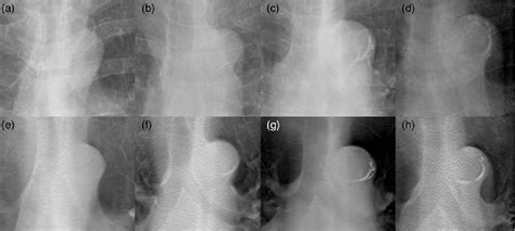 Digital tomosynthesis for aortic arch calcification evaluation ...