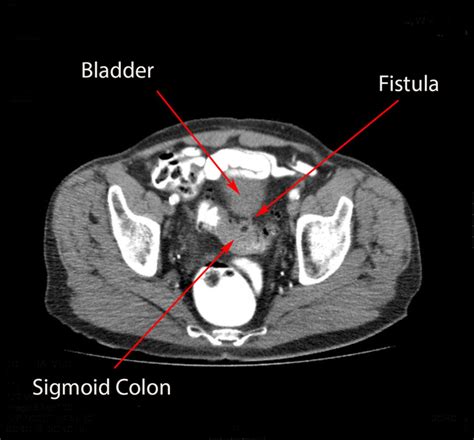 Colovesical Fistula Presenting With Epididymitis Bmj Case Reports